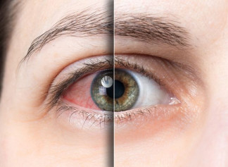 Синдром сухого глаза: причины, лечение, профилактика